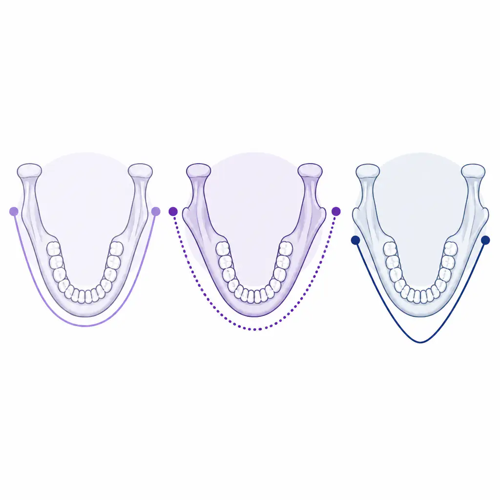 Top-down jaw silhouette comparison showing outward flared gonions versus neutral versus inward flared gonions