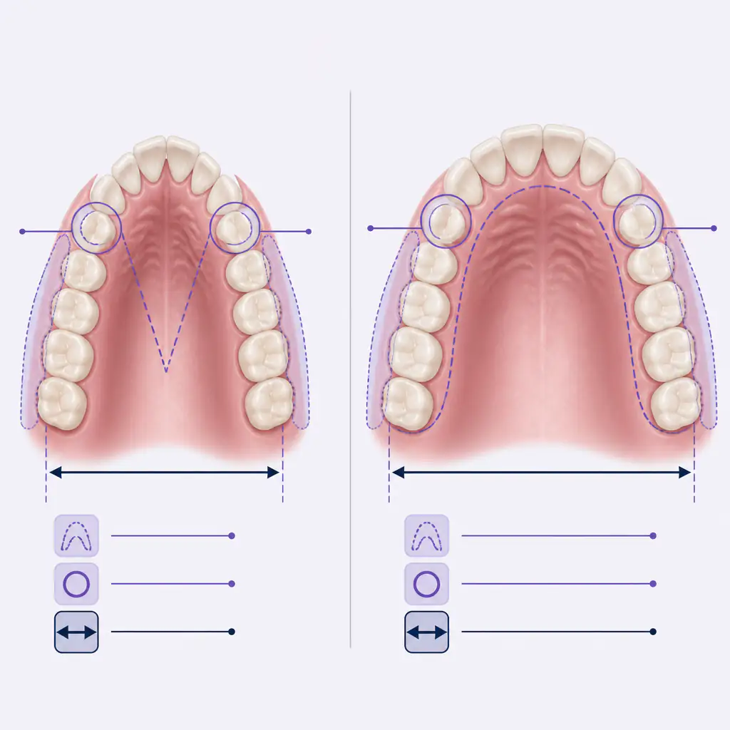 Comparison diagram of narrow vs wide palate arch shape viewed from below